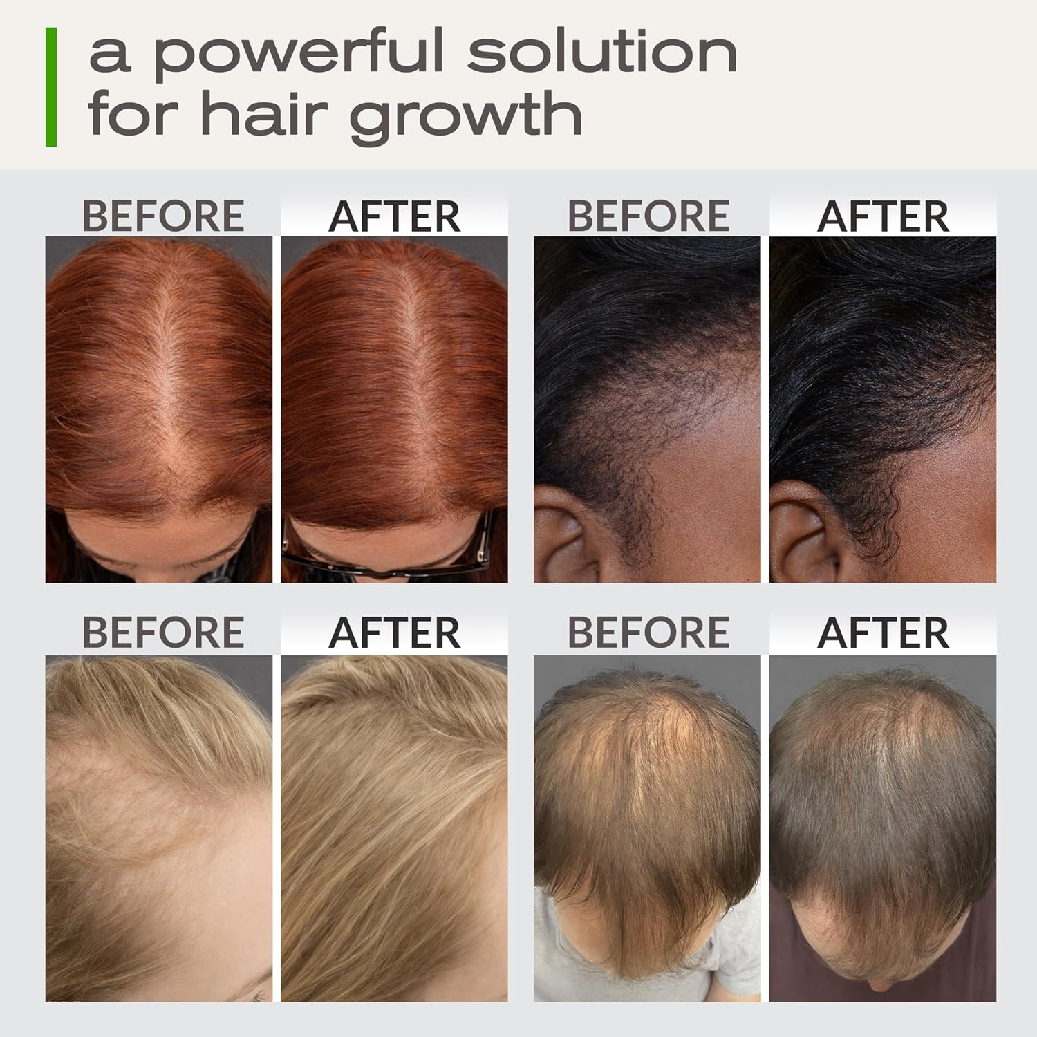 Complete Hair Growth Bundle
